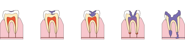 むし歯の進行図