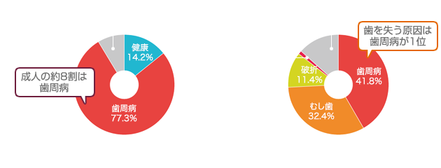 現代人の歯を失う最大の原因は歯周病です。