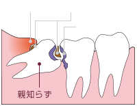 親知らずの問題